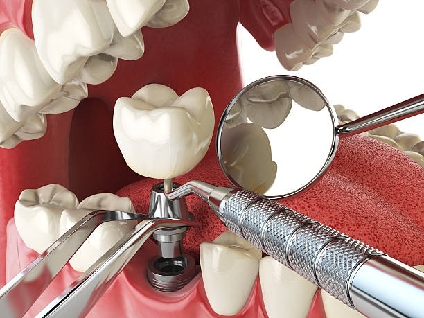 Best Emergency Treatment for Dental Infections or Abscesses in Folkston, GA